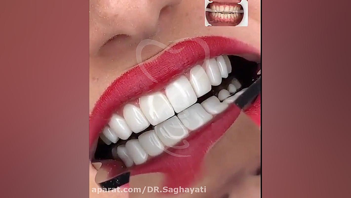 کامپوزیت ونیر - دکتر سقایتی - 02126852682 تست تحریک ACTH