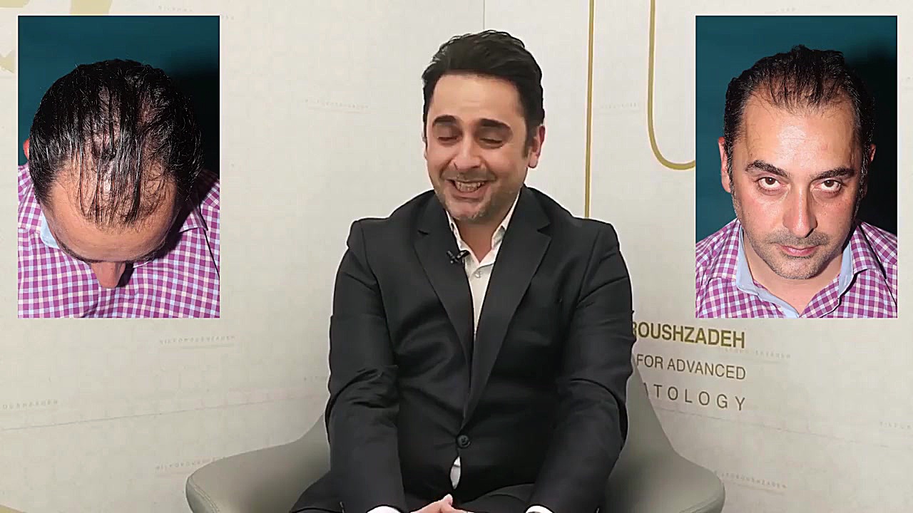 کاشت مو آقای علیرضا مقصود خبرنگار و گوينده اخبار اقتصادی شبکه خبر سیما پیلینگ