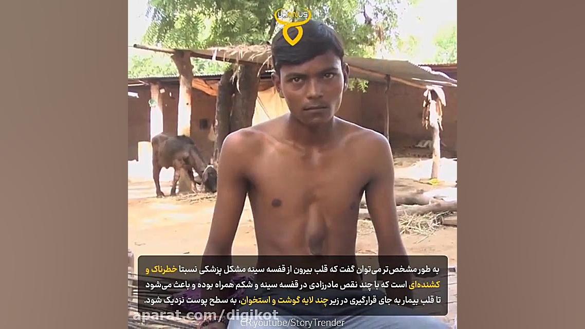 قلب پسر 18 ساله که خارج از قفسه سینه و در زیر پوست قرار دارد اندودنتیکس