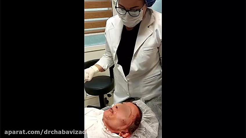 فیلم واقعی لیفت صورت با نخ - پارت سوم دکتر صفیه چعباوی زاده