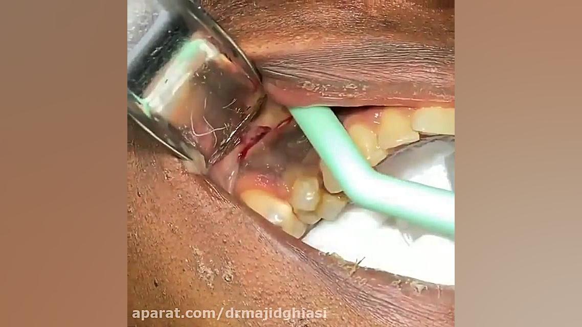 عفونت لثه دکترمجیدقیاسی