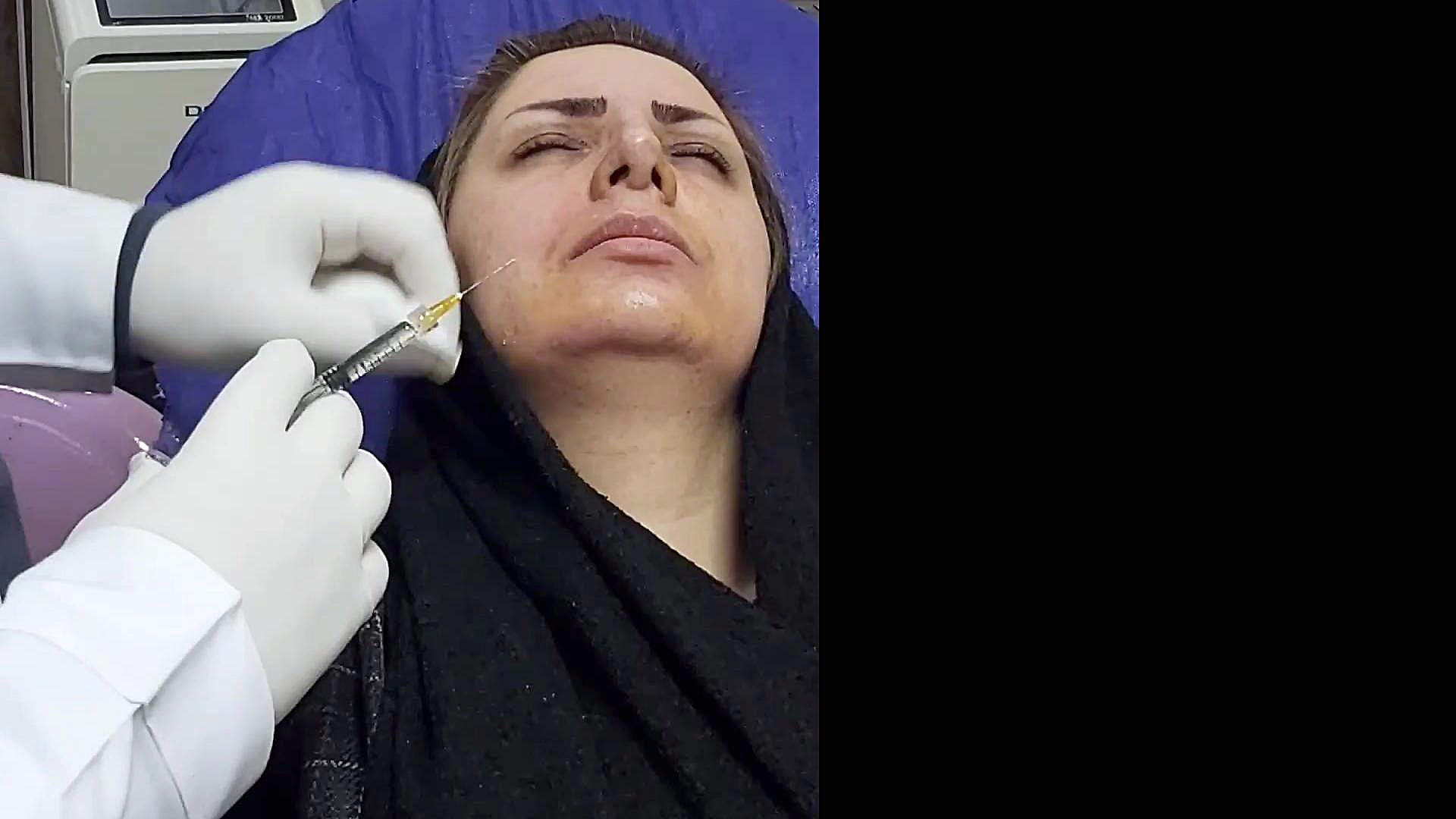 تزریق ژل خط خنده اصفهان متخصص پوست اصفهان دکتر مهدی سبکتکین