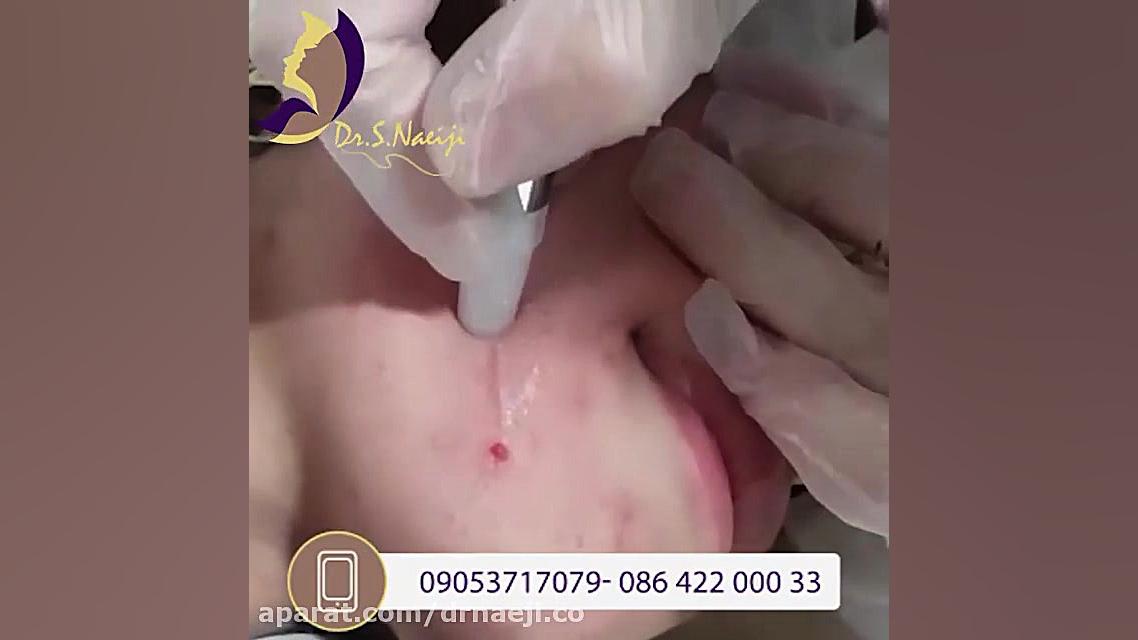 فیلم واقعی از بین بردن آکنه با میکرودرم ابریشن دکتر صدیقه نائیجی | متخصص پوست و مو در قم