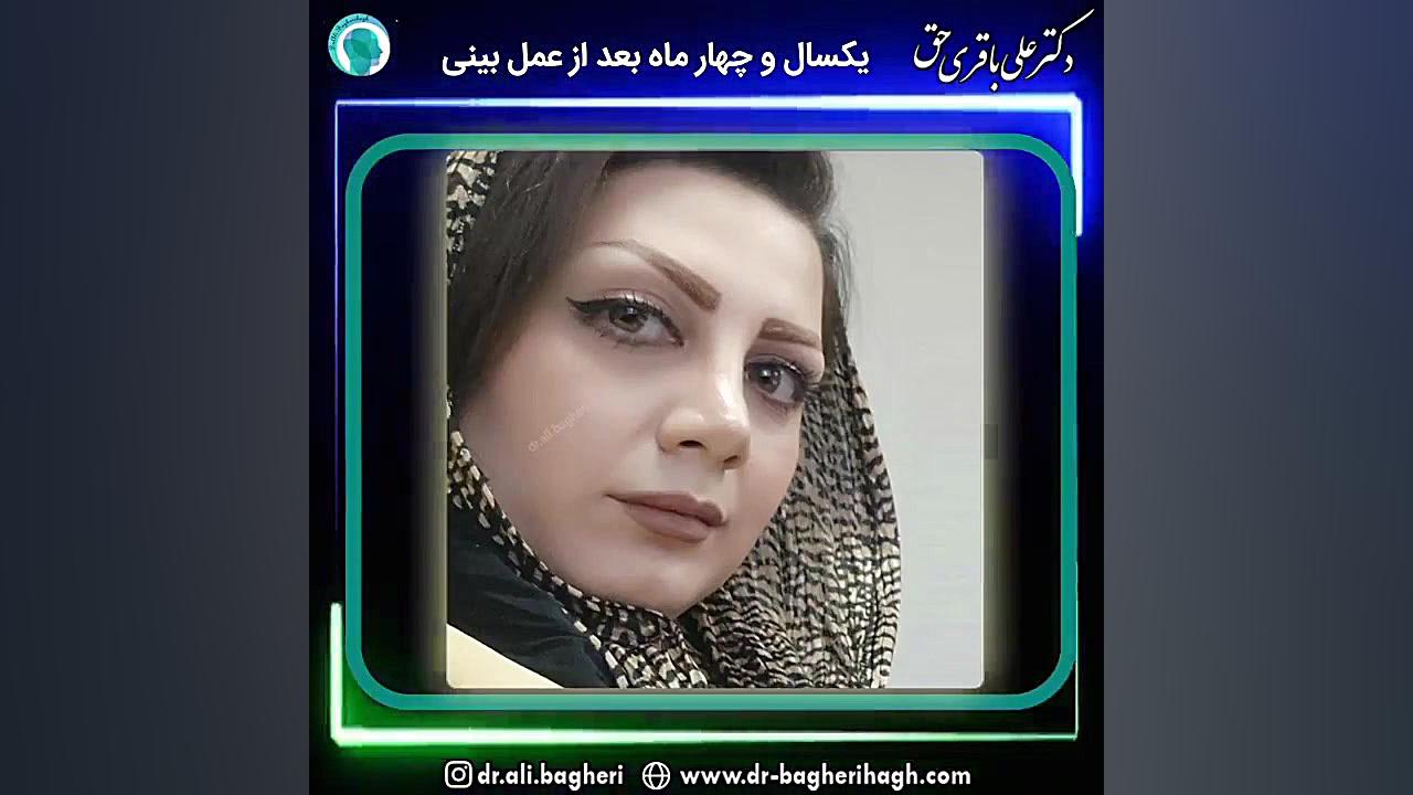 یک سال و چهار ماه بعد از جراحی بینی دکتر علی باقری حق