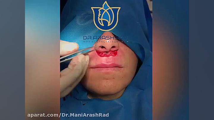 لیفت سانترال لب دکتر مانی آرش راد جراح فك و صورت