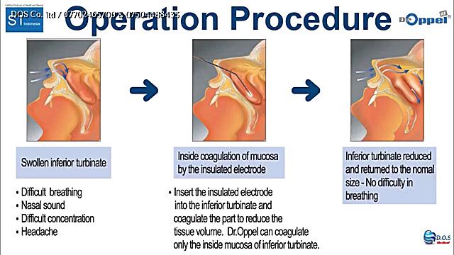 جراحی های گوش و حلق و بینی با دستگاه رادیو فرکانسی الکترو سرجری Dr.oppel ایریدوتيكان