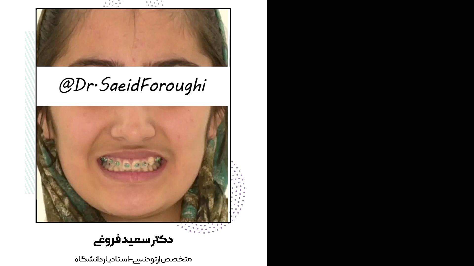 ارتودنسی ثابت دکتر سعید فروغی متخصص ارتودنسی