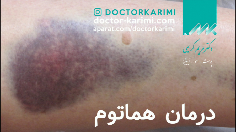 درمان هماتوم به وسیله LDM سلفی