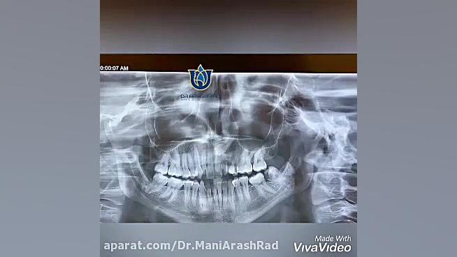 عمق نیش نهفته در تصاویر رادیوگرافی دکتر مانی آرش راد جراح فك و صورت