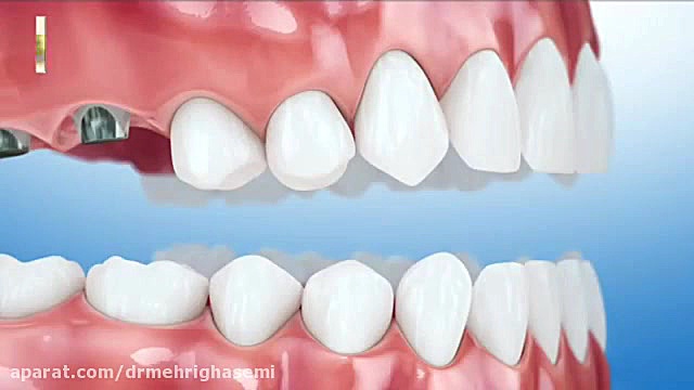 لیفت سینوس | کلینیک دندانپزشکی دیجیتال دکتر مهری قاسمی مرکز دندانپزشکی دیجیتال دکتر مهری قاسمی
