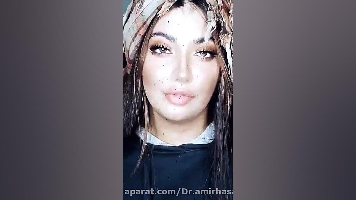 دکتر حسن پور اصفهان دکتر زیبایی جشنواره یلدا کامپوزیت دکتر امیر حسن پور دندانپزشک زیبایی اصفهان