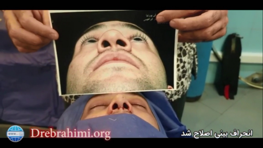 عمل بینی گوشتی کج توسط دکتر امید ابراهیمی بهترین جراح بینی در تهران دکتر امید ابراهیمی