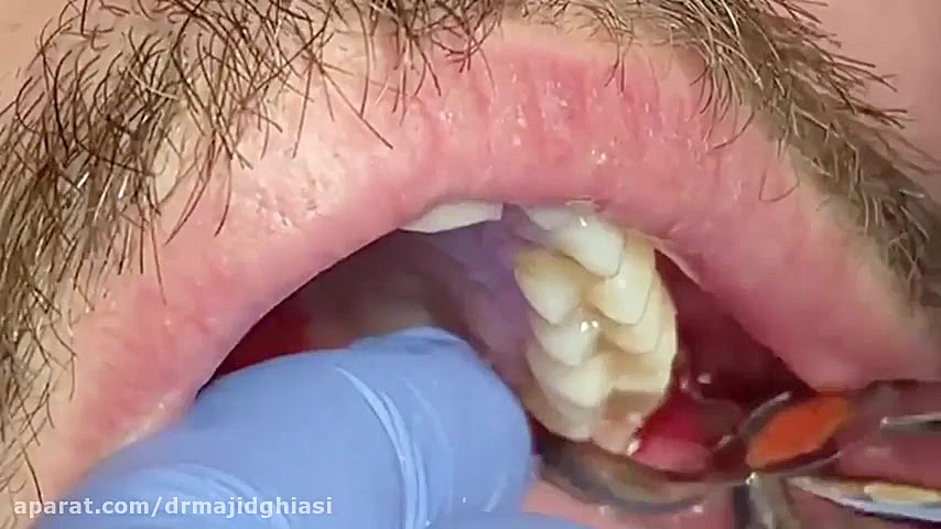 جراحی دندان عقل -دکترمجیدقیاسی دکترمجیدقیاسی