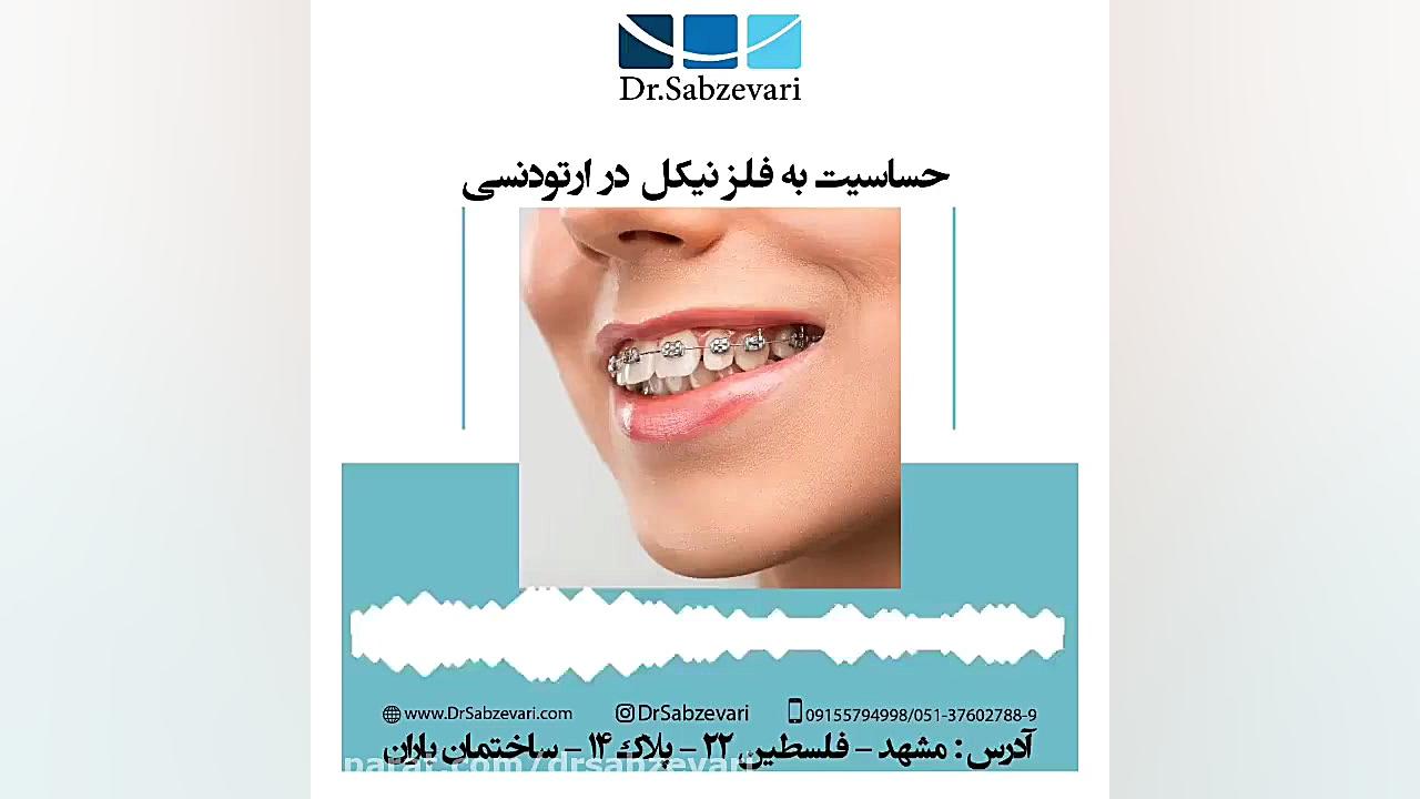 حساسیت به فلز نیکل در ارتودنسی دکتر برهمن سبزواری - متخصص ارتودنسی - مشهد