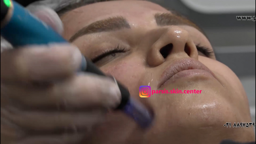 میکرونیدلینگ، روند اجرا آزمایش ایمونوسورپشن