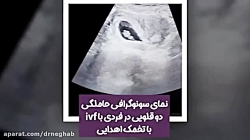 فیلم سونوگرافی حاملگی دوقلویی