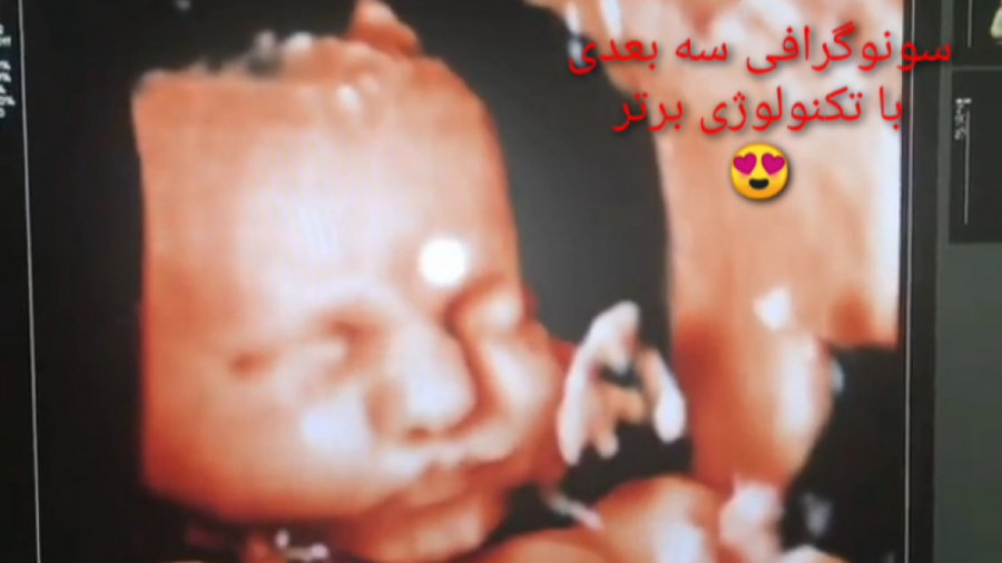 سونوگرافی سه و چهار بعدی با تکنولوژی برتر روز(نور چراغ قوه) توسط دکتر خواجه پور رابرت داونی جونیور