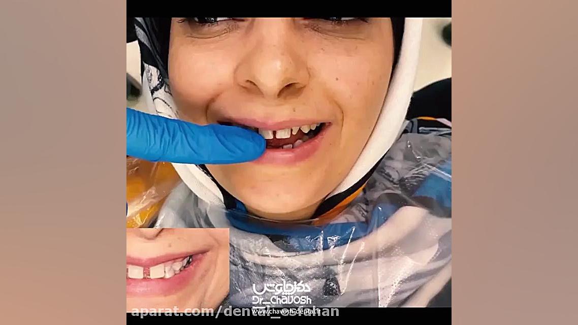 درمان پیچیده ارتودنسی جراحی لثه کامپوزیت ونیر به رنگ سفید صدفی طبیعی کاپوت سکودانئوم