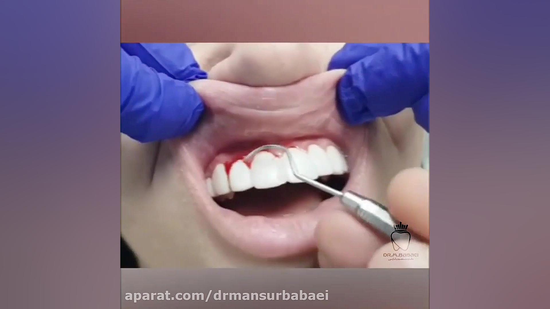 راز کامپوزیت های ارزان قیمت دکتر منصور بابایی