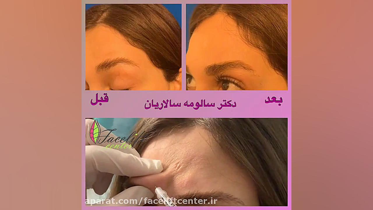 تزریق بوتاکس بین دو ابرو جم‌سیتابین