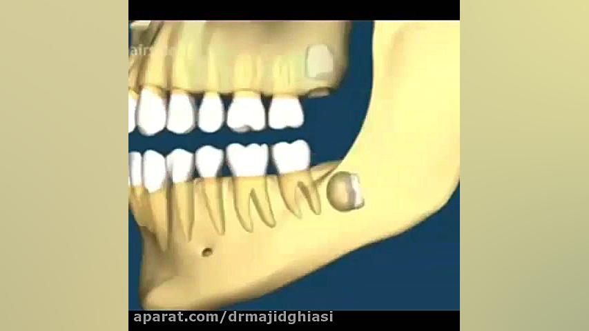 جراحی دندان عقل نهفته دکترمجیدقیاسی