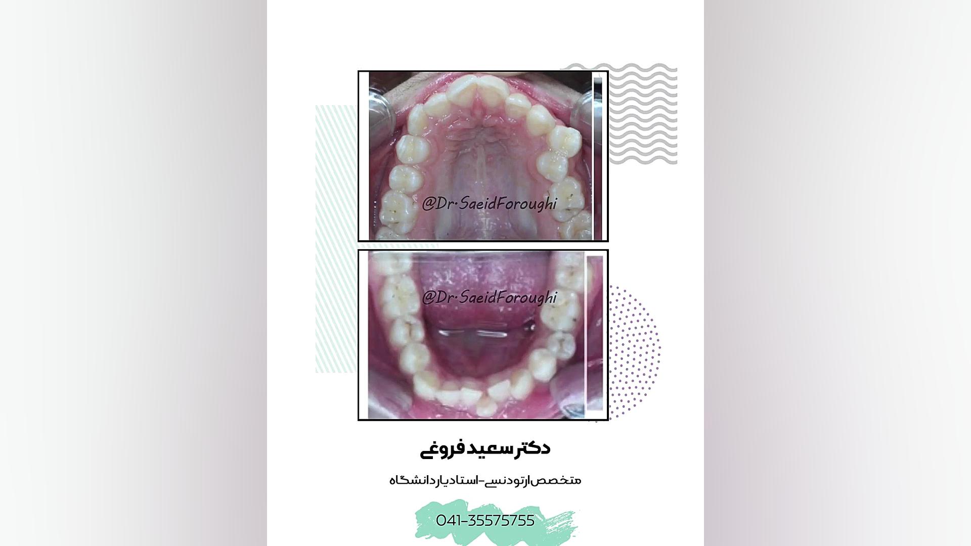 درمان بی نظمی شدید دندانها و ایجاد تقارن و هماهنگی دندانهای دو فک توسط ارتودنس دکتر سعید فروغی متخصص ارتودنسی