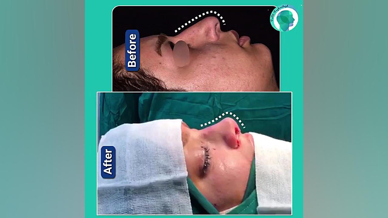 جراحی زیبایی بینی دکتر علی باقری حق