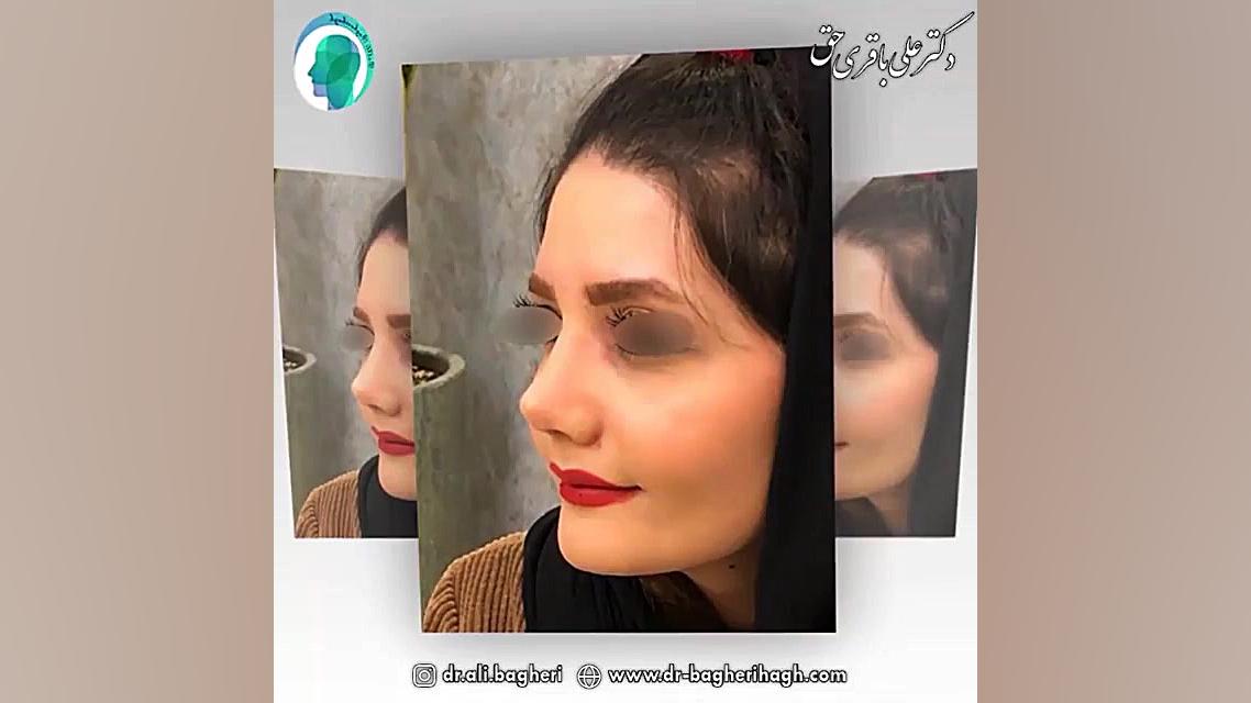 قبل و بعد جراحی بینی دکتر علی باقری حق
