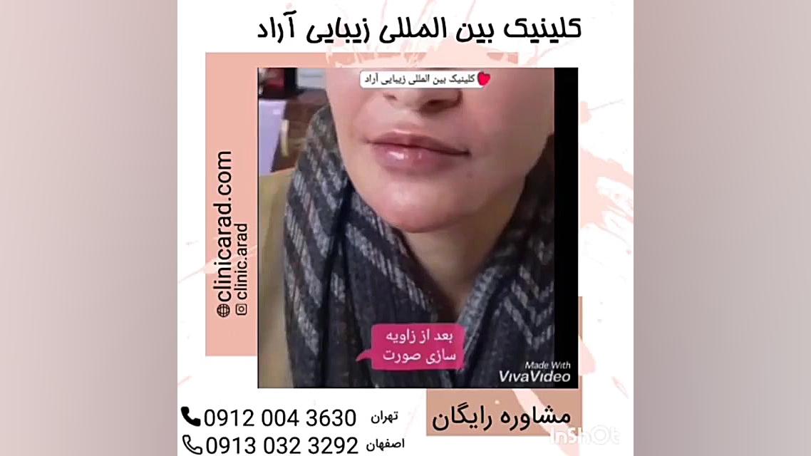 زاویه سازی صورت میکروالکترود آرایه‌ای