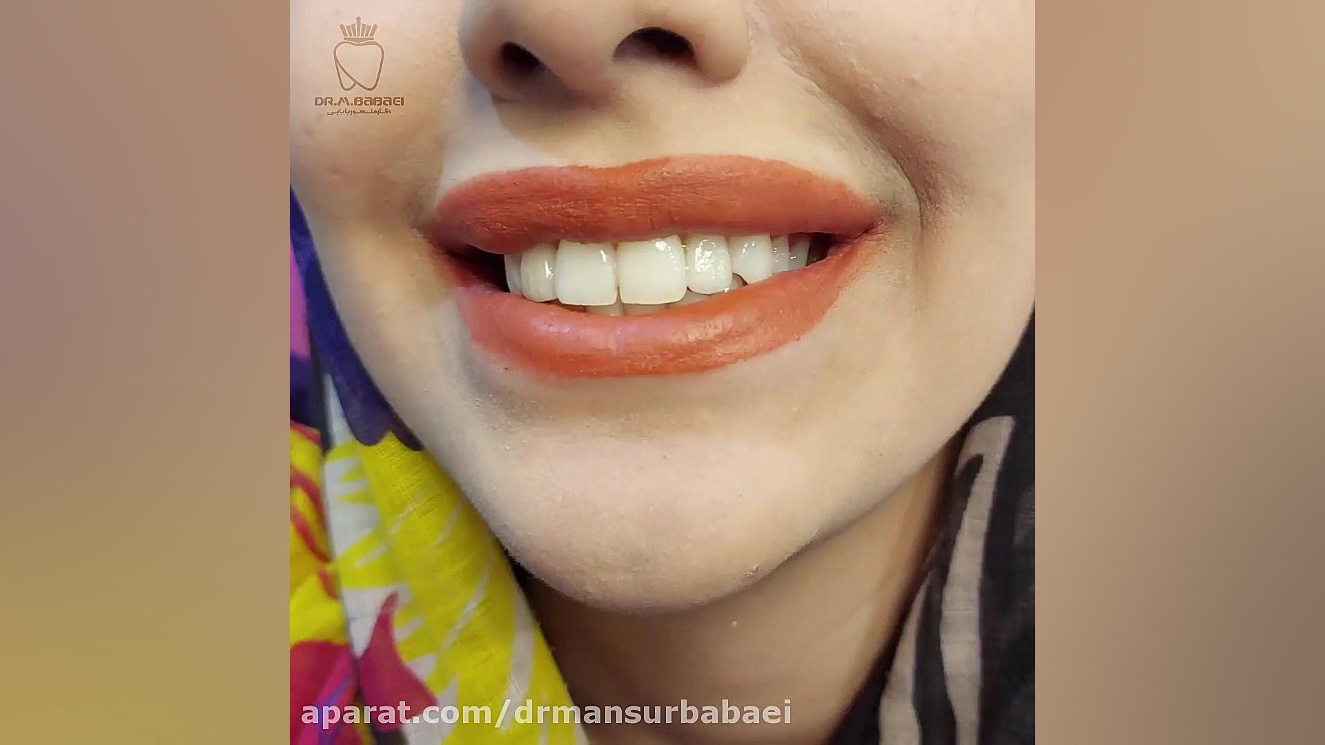 با کمی تغییر، لبخند زیبایی بازآفرینی شد دکتر منصور بابایی