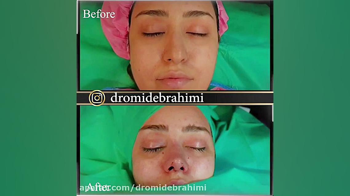 جراحی زیبایی بینی توسط دکتر امید ابراهیمی بهترین جراح بینی در تهران دکتر امید ابراهیمی