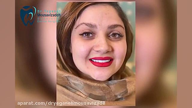 رضایـت از کامپوزیت ونیــر TWA