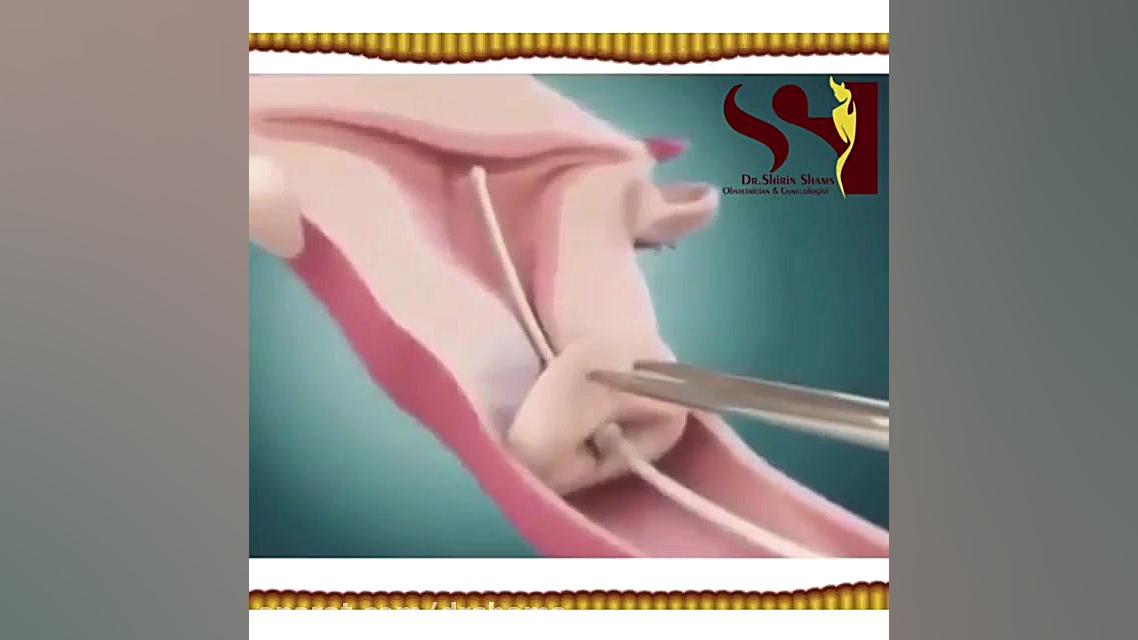 چگونگی قرار دادن IUD در رحم دکتر شیرین شمس جراح و متخصص زنان و زایمان