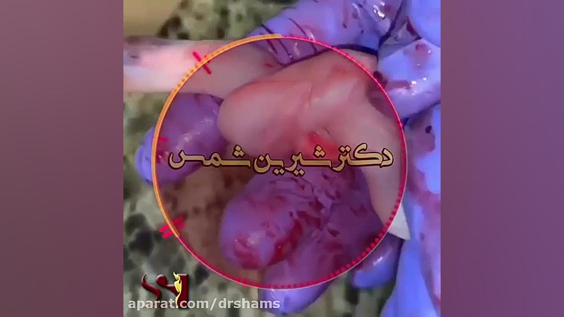 گره خوردن بند ناف دکتر شیرین شمس جراح و متخصص زنان و زایمان