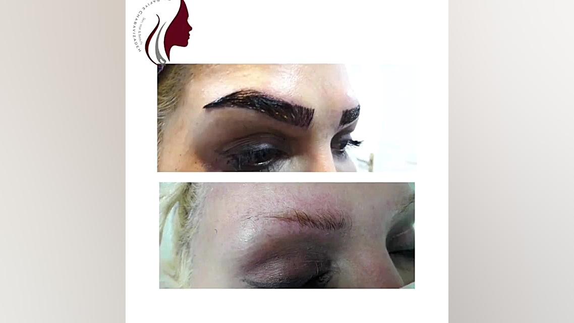 فیلم واقعی کاشت ابرو دکتر صفیه چعباوی زاده