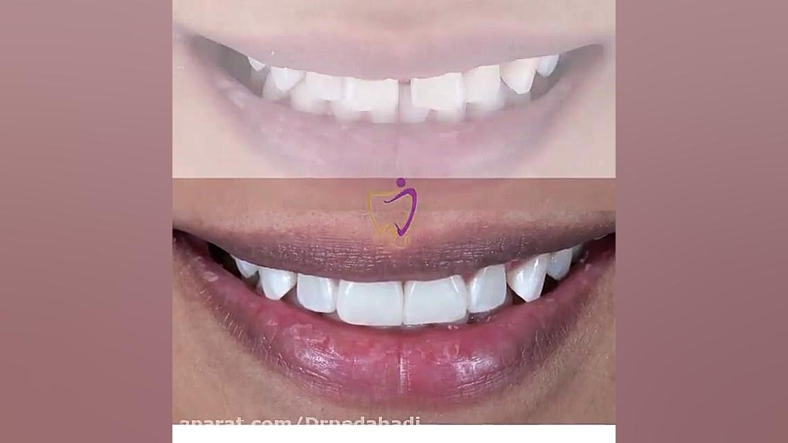 لبخند زیبای یکی دیگر از مراجعه کنندگان عزیزمون دکتر ندا هادی-دندانپزشک زیبایی
