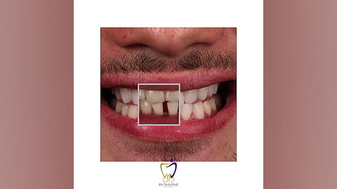 لبخند زیبای یکی دیگر از مراجعه کنندگان عزیزمون دکتر ندا هادی-دندانپزشک زیبایی