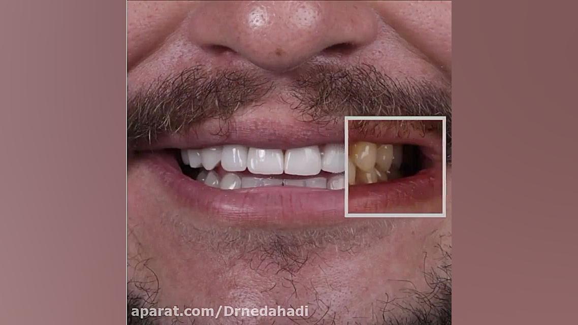 لبخند مراجعه کننده عزیز بعد از انجام کار زیبایی دکتر ندا هادی-دندانپزشک زیبایی