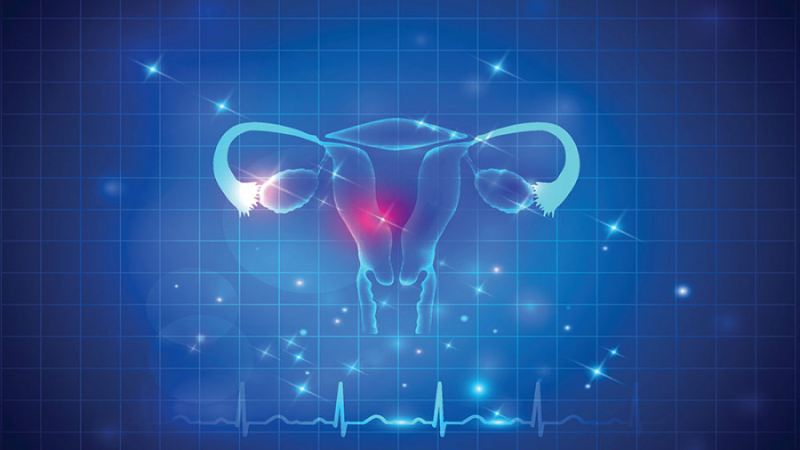رژیم غذایی در تخمدان پلی کیستیک - دکتر الهام اختری متخصص طب سنتی اکستنشن تاج دندان