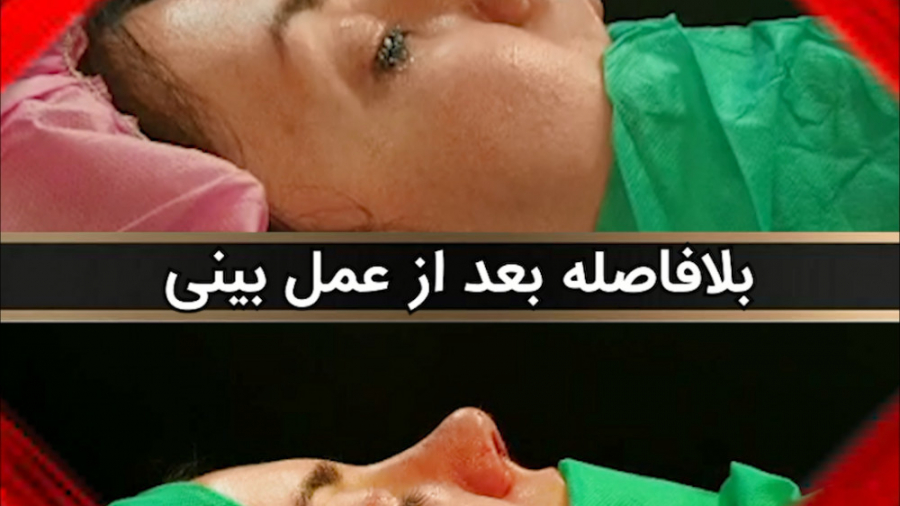 عمل زیبایی بینی قوز دار توسط دکتر امید ابراهیمی بهترین جراح بینی در ایران دکتر امید ابراهیمی