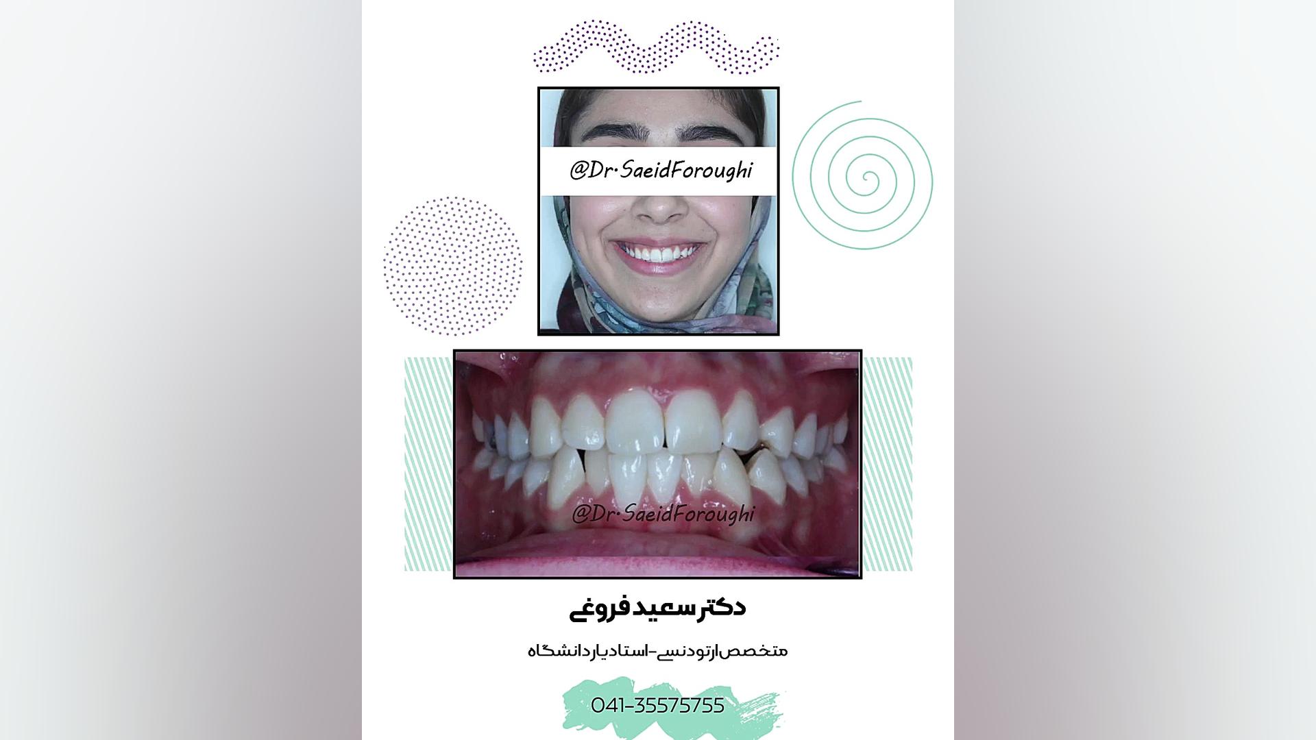 اصلاح ناقرینگی قوس فک بالا و رفع بینظمی دندانها توسط ارتودنسی ثابت دکتر سعید فروغی متخصص ارتودنسی