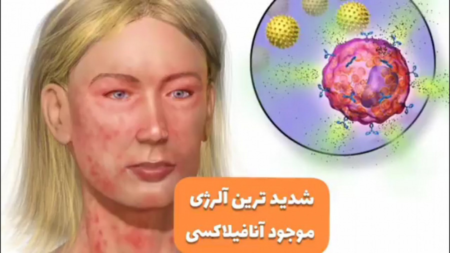 فیلم جالب از شدیدترین آلرژی افراد بلیچینگ دندان