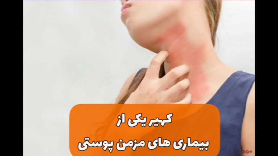 فیلم جالب در مورد بیماری کهیر دکتر یعقوب محبوبی اسکوئی