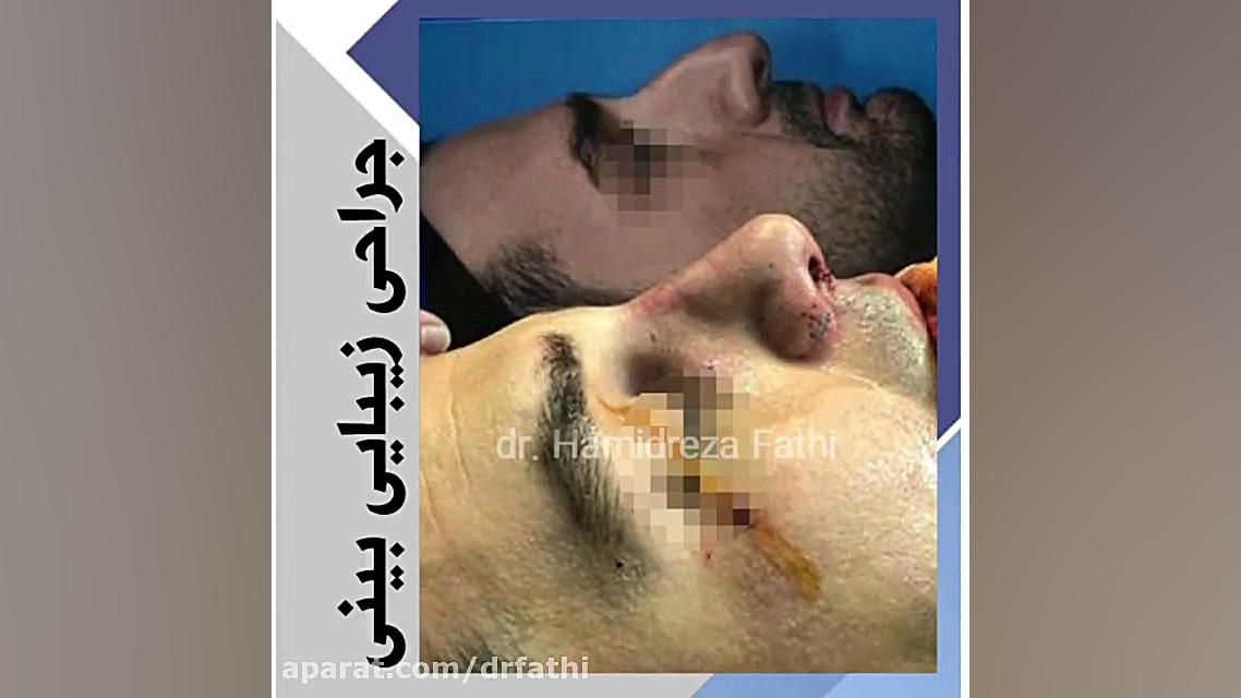 عمل بینی توسط دکتر حمید رضا فتحی دکتر حمید رضا فتحی فوق تخصص جراحی پلاستیک