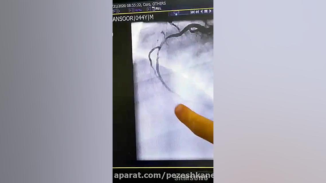 دکتر علی معصومی متخصص قلب و عروق و بالون آنژیوپلاستی رفع غبغب