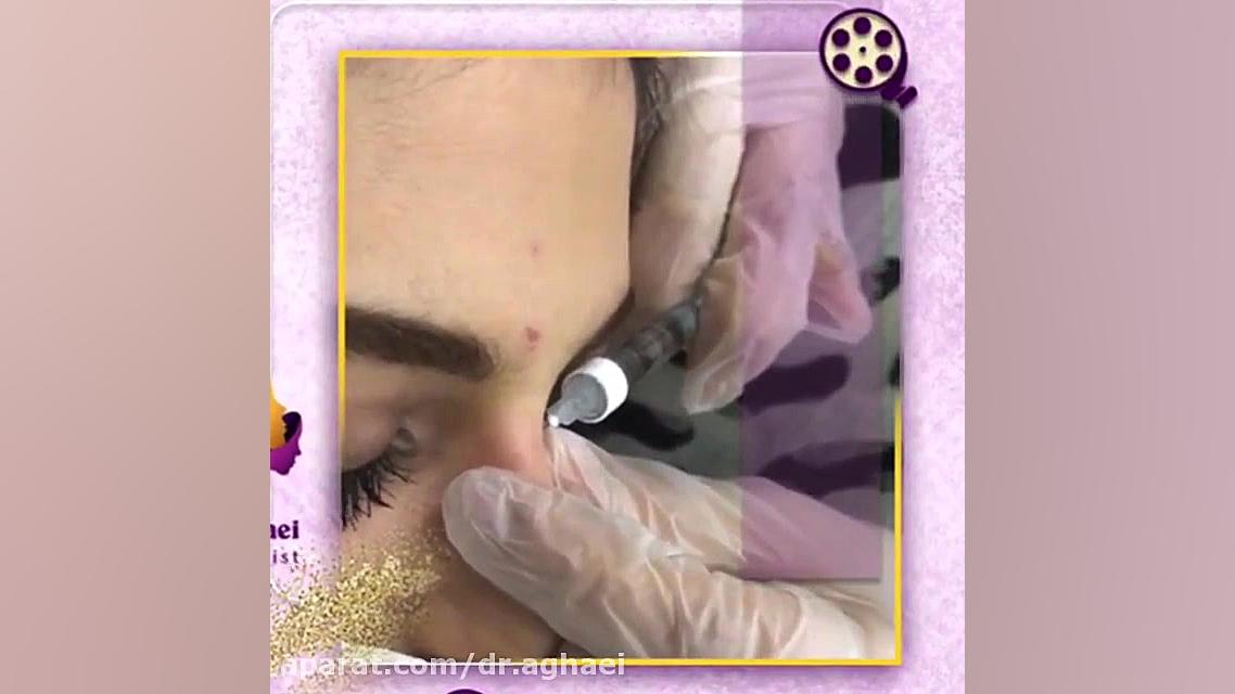 فیلم واقعی تزریق فیلر به بینی دکتر حمیده آقایی