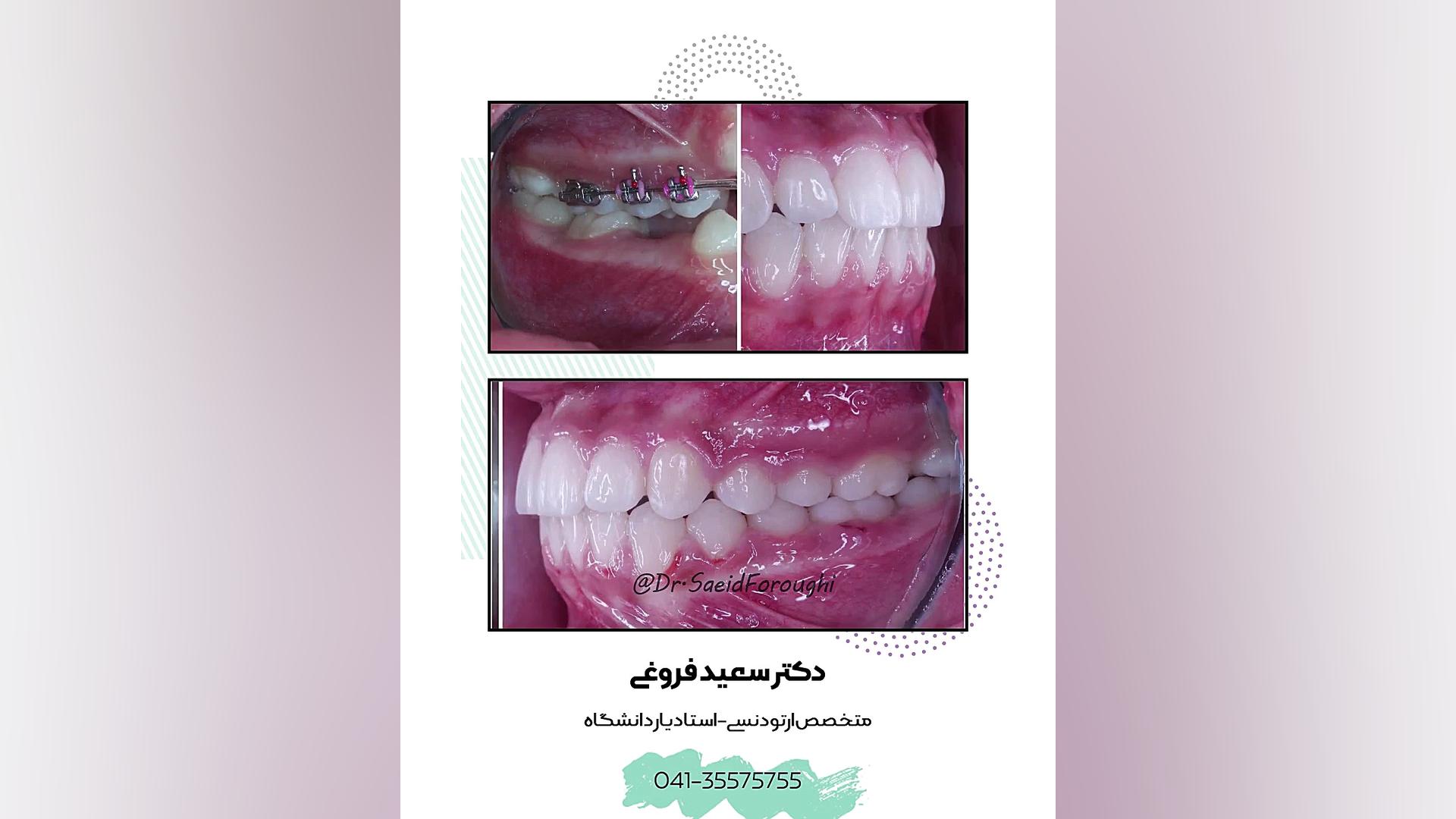رفع بی نظمی دندانها دکتر سعید فروغی متخصص ارتودنسی