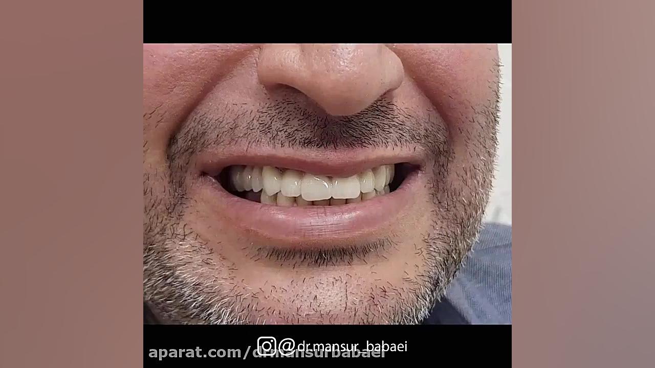 بازسازی کامل فک بالا بوسیله روکش های PFM دکتر منصور بابایی