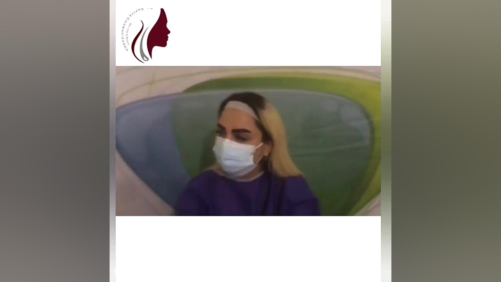 فیلم واقعی کاشت ابرو و نتیجه آن دکتر صفیه چعباوی زاده