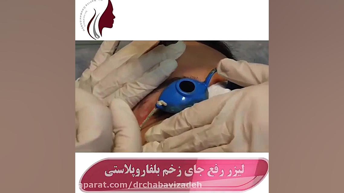 فیلم واقعی لیزر رفع جای زخم بلفاروپلاستی از نزدیک دکتر صفیه چعباوی زاده